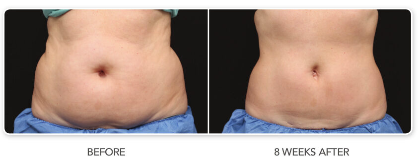 fat loss colts neck