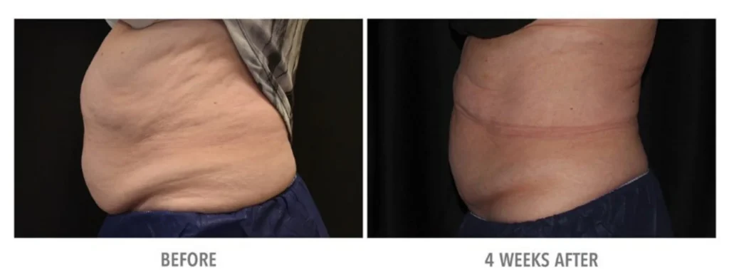 cryolipolysis