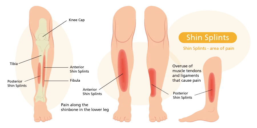 Prevention and Treatment for Shin Splints